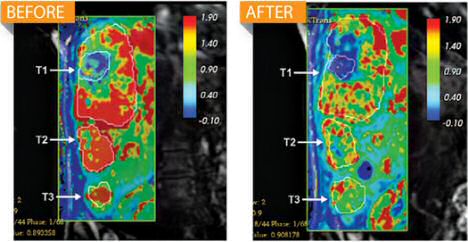 Less blood flow in liver tumors before and after ALN-VSP therapy