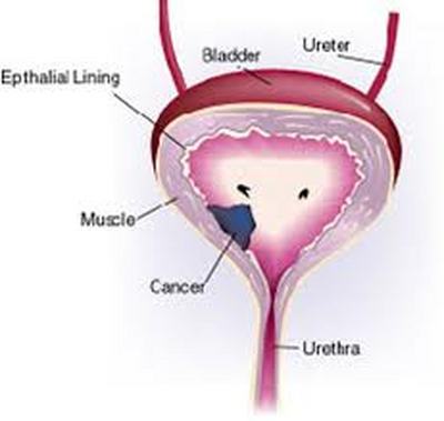 Bladder cancer