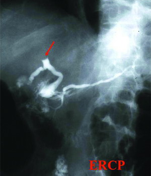 cholangiocarcinoma