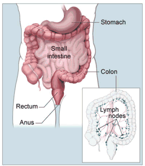 colon cancer treatment lymph nodes
