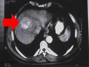 Hepatocellular carcinoma