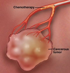 hepatocellular chemoembolization