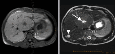 metastatic liver cancer prognosis