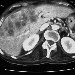 secondary liver cancer