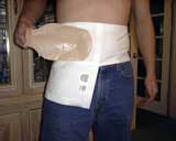 stoma belt