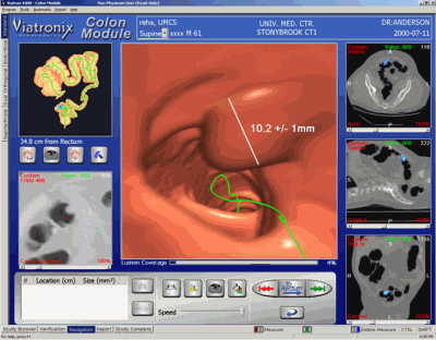 virtual colonoscopy